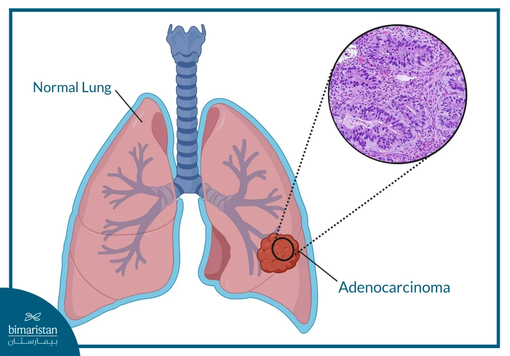 Lung Adenocarcinoma: Causes, Symptoms &Amp; Treatment 3 Illustration Showing Lung Adenocarcinoma In The Lower Lobe, With A Microscopic View Of Cancer Cells