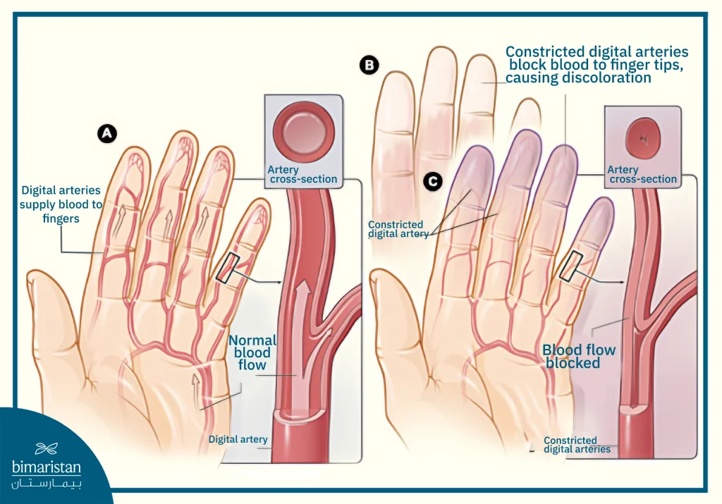 Illustration Showing Normal And Blocked Blood Flow In Fingers