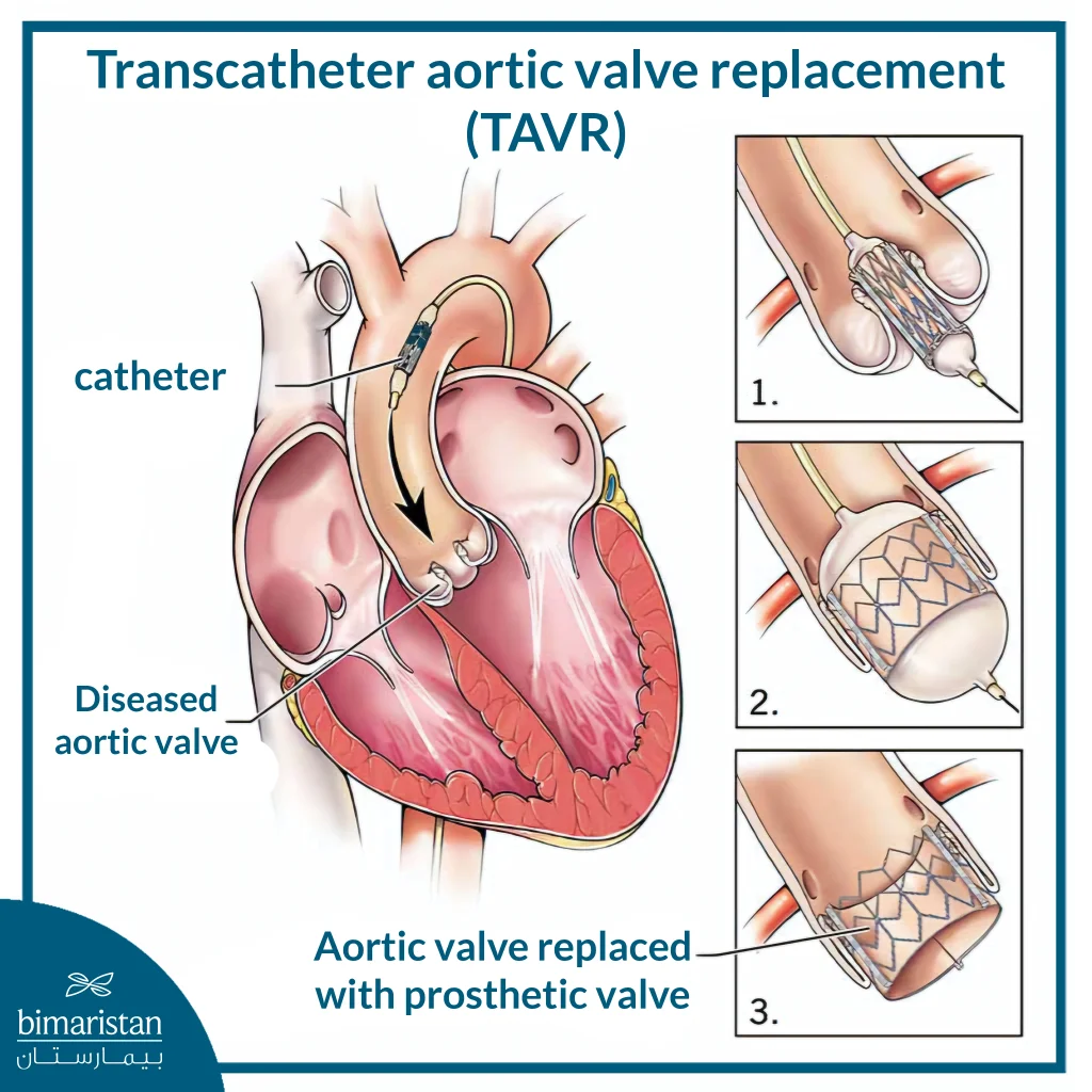 Illustration Showing Step-By-Step Transcatheter Aortic Valve Replacement