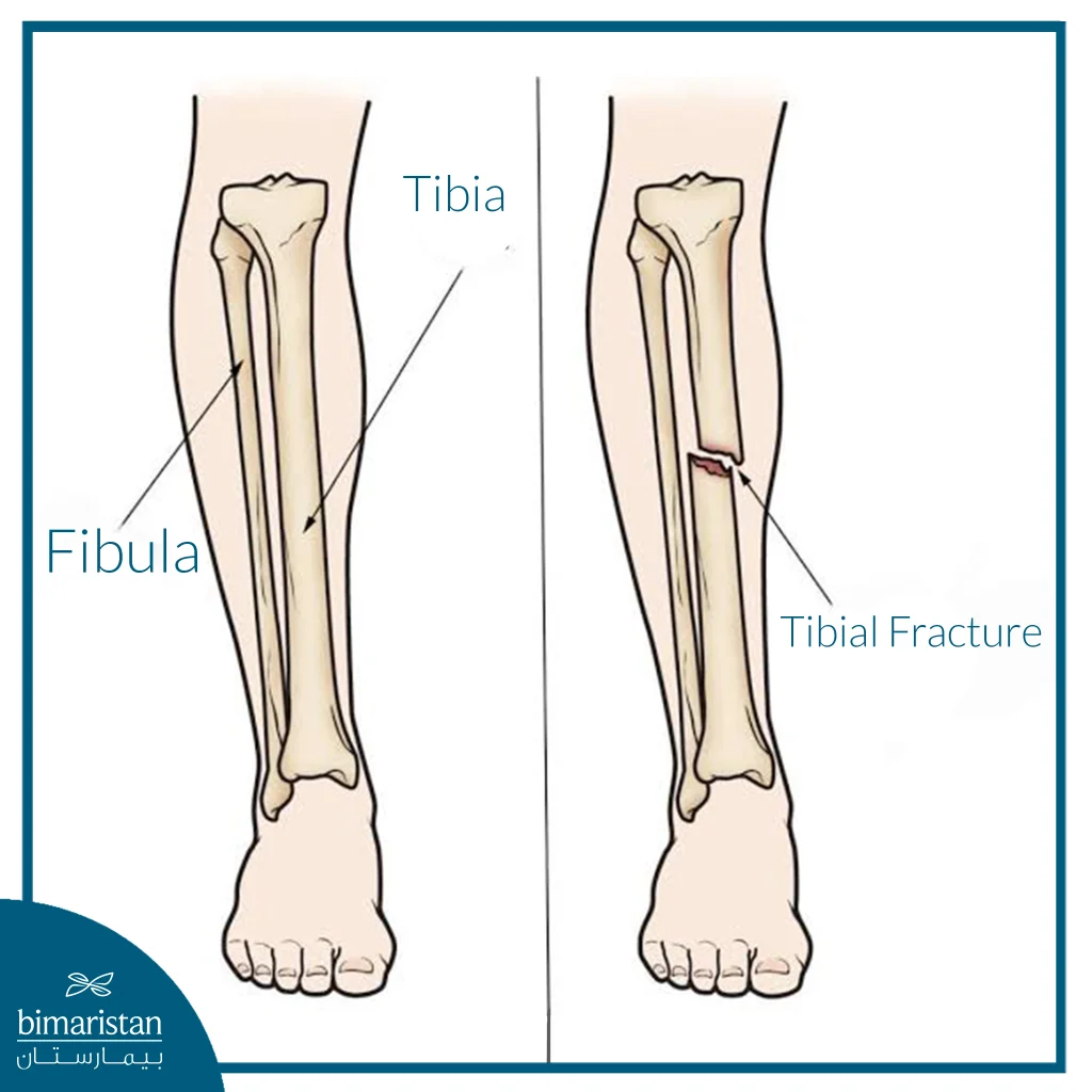 Image Showing A Tibial An Image Showing A Tibial Fracture