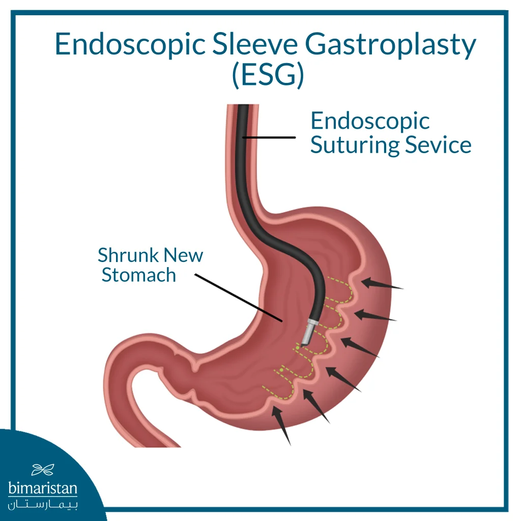 Endoscopic Sleeve Gastroplasty (Esg): The Modern Technique For Non-Surgical Weight Loss 4 Image Explaining The Procedure Of Esg.