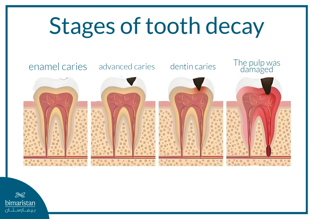 Image Illustrating The Stages Of Tooth