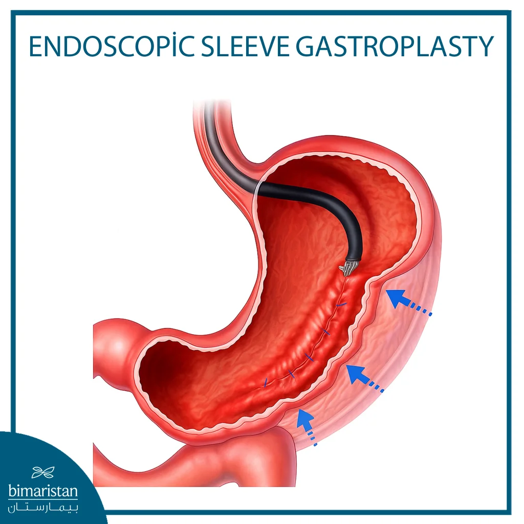 Image Showing Endoscopic Sleeve Gastrectomy (Esg)