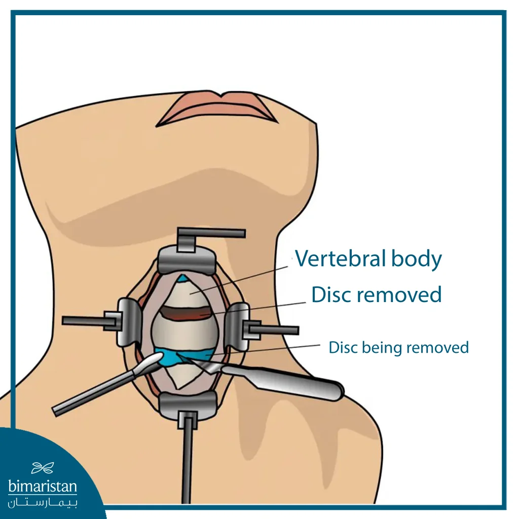 Image Showing An Anterior Cervical Discectomy And Fixation (Acdf) Procedure