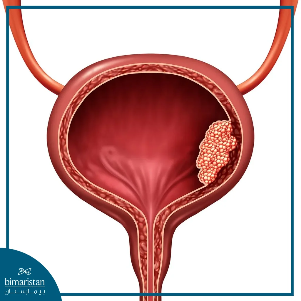 Bladder Cauterization For Women In Turkey: Safe &Amp; Advanced Treatment Guide 2025 3 Image Showing Bladder Tumors That May Require Bladder Cauterization For Women