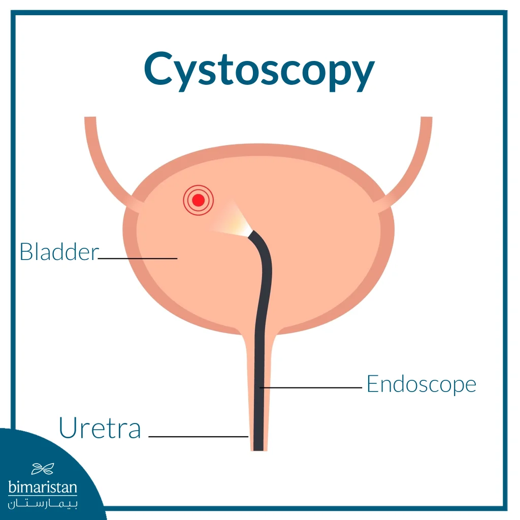 Bladder Cauterization For Women In Turkey: Safe &Amp; Advanced Treatment Guide 2025 2 Image Showing Cystoscopy Procedure For Accessing The Bladder