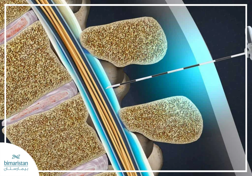 Image Showing Epidural Injections To Treat Disc Herniation Pain
