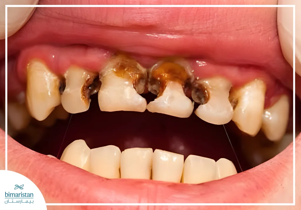 Image Showing Tooth Decay In Infants, Also Known As Baby Bottle Syndrome.