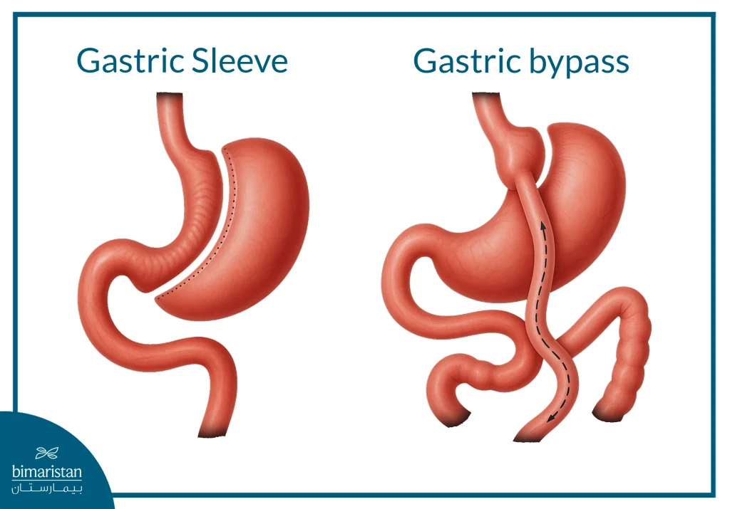 Endoscopic Sleeve Gastroplasty (Esg): The Modern Technique For Non-Surgical Weight Loss 5 Image Showing The Difference Between Gastric Sleeve And Gastric Bypass.