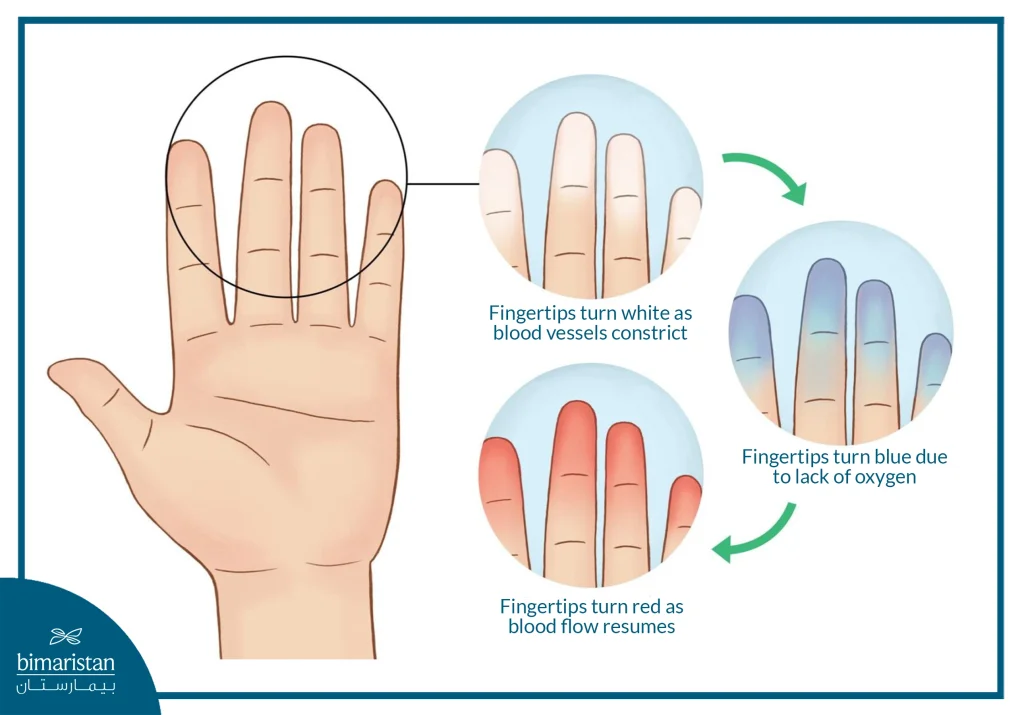 Image Showing The Triphasic Color Changes In Raynaud’s Phenomenon