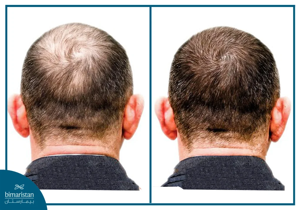 Exosome Hair Therapy: The Latest In Natural Hair Regeneration 3 Image Showing Visible Hair Density Improvement Before And After Exosome Therapy.
