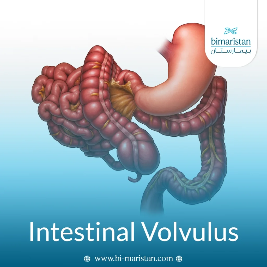 Intestinal Volvulus