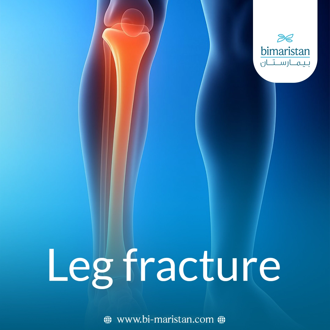 Leg Fracture