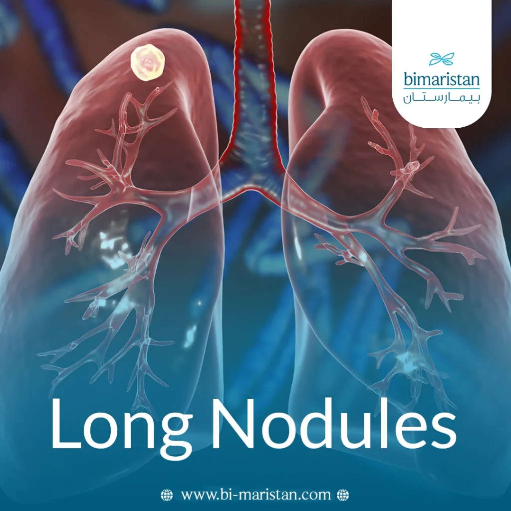 Long Nodules