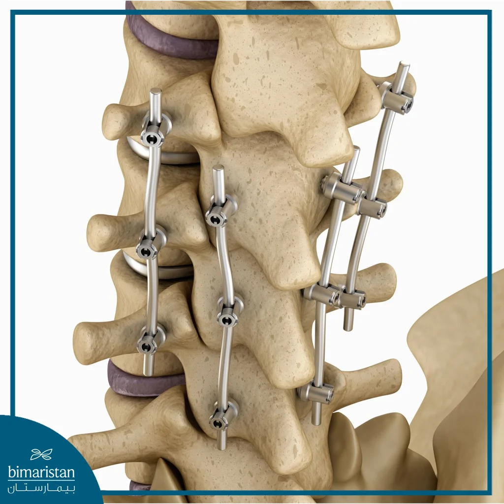 Lumbar Spine Fixation What Does It Offer Us
