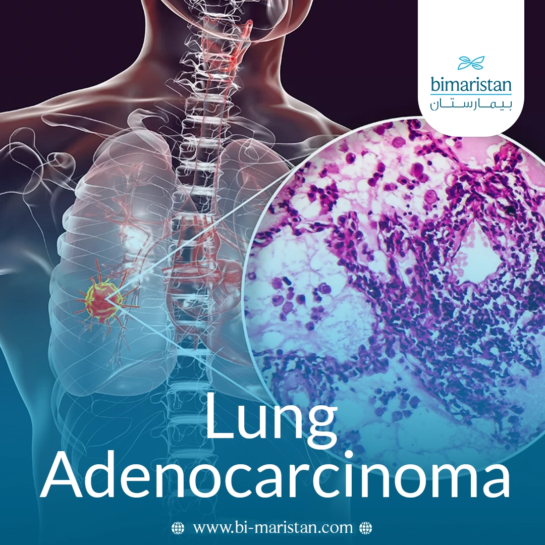 Lung Adenocarcinoma