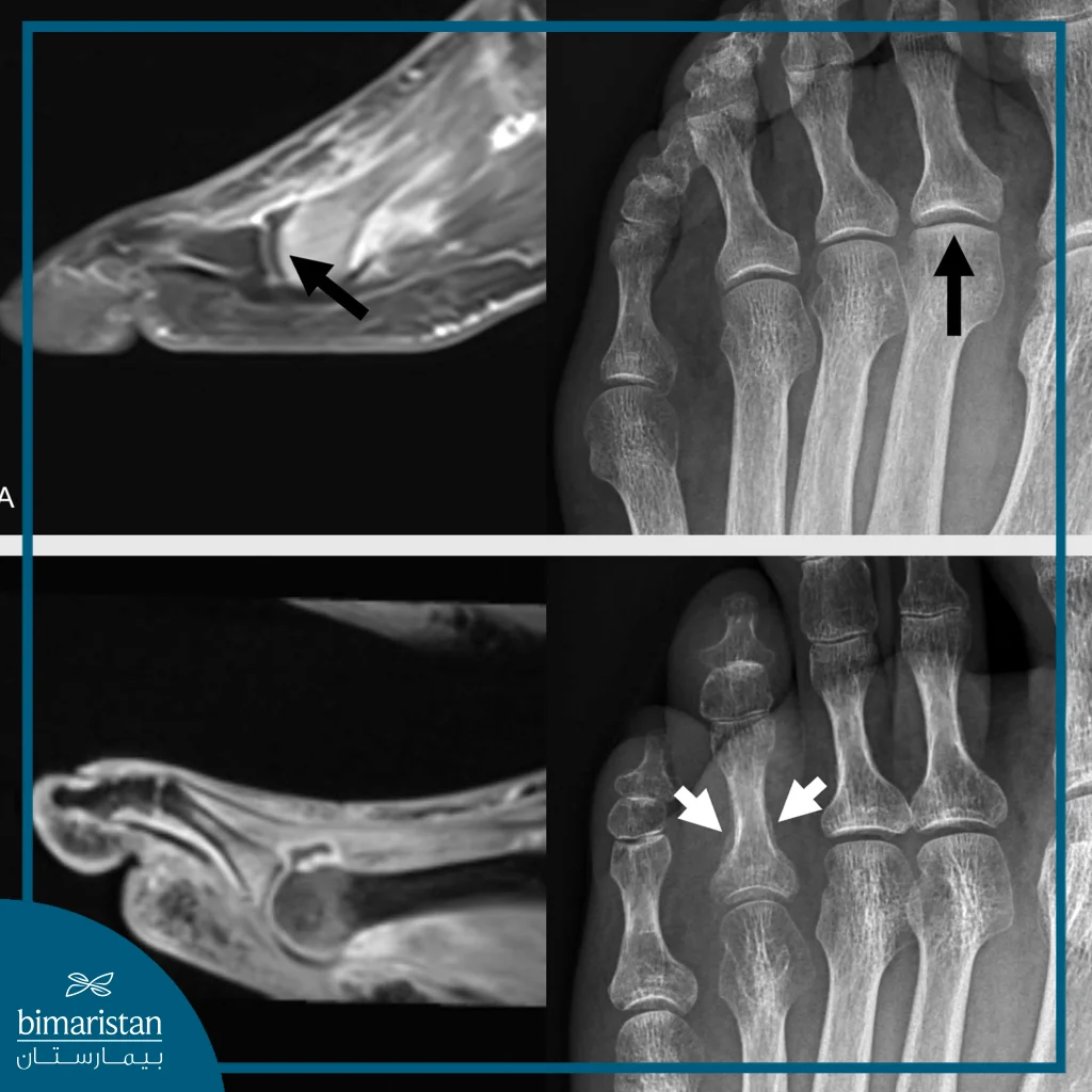Mri Image Showing A Clear Fracture In The Foot