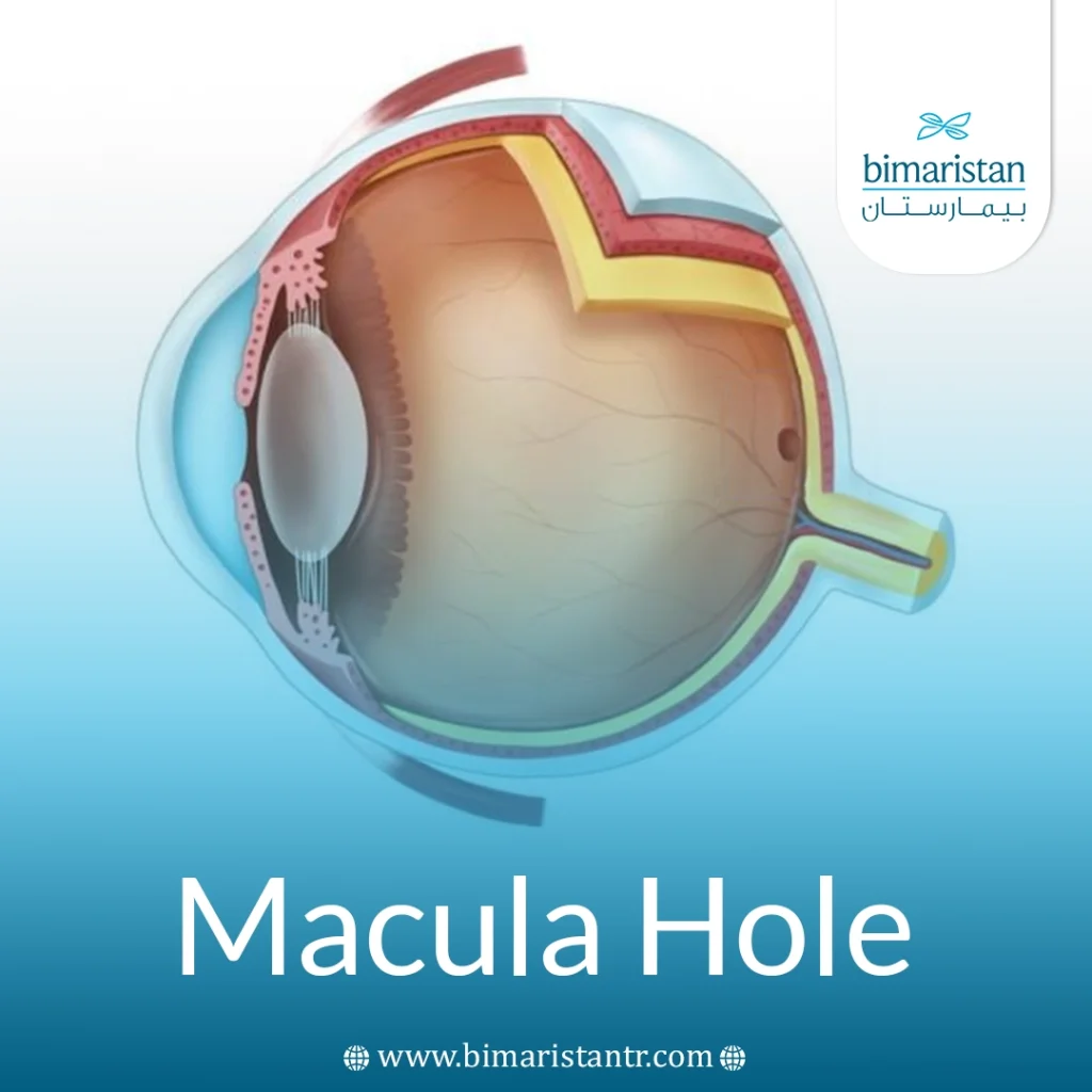 Macula Hole