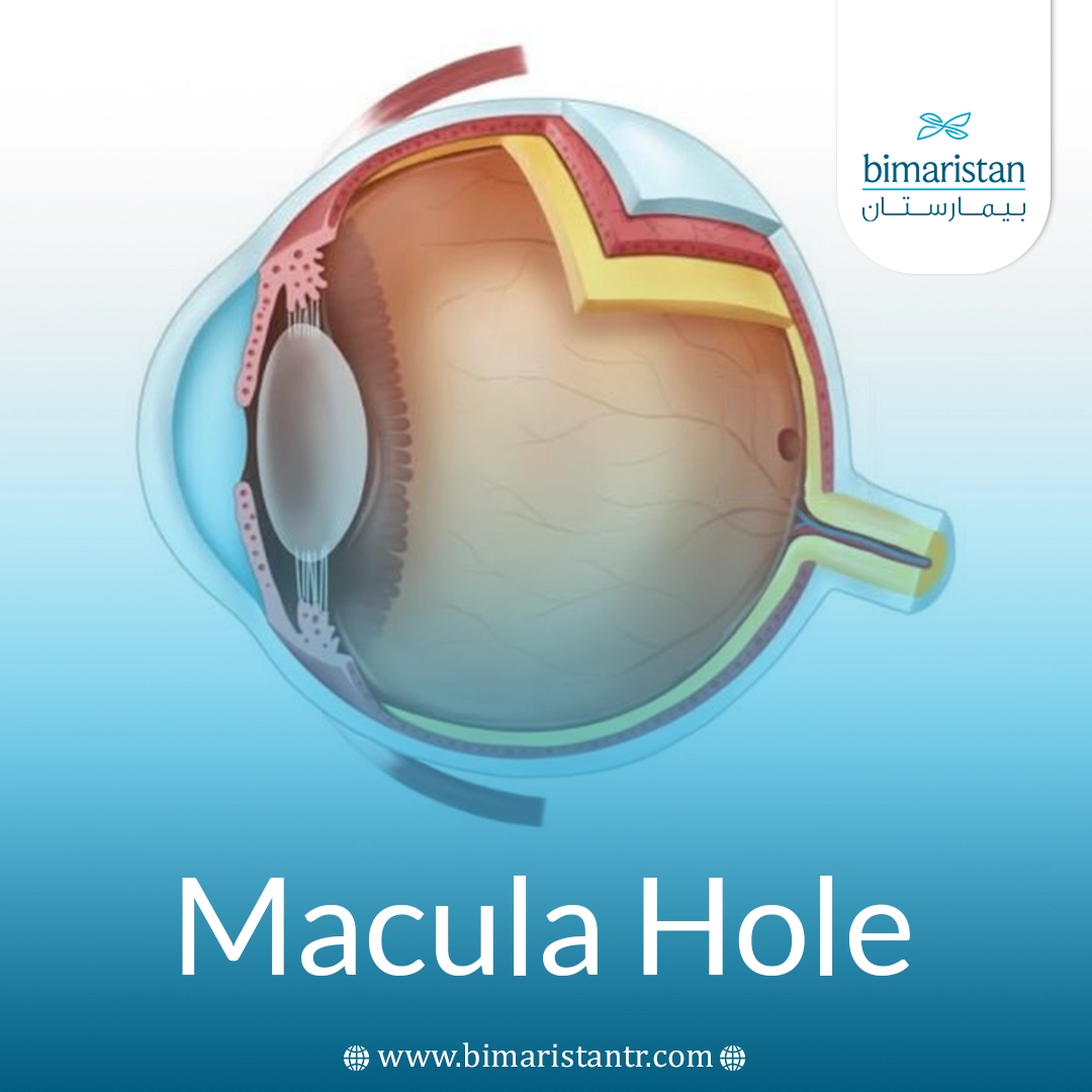 Macula Hole