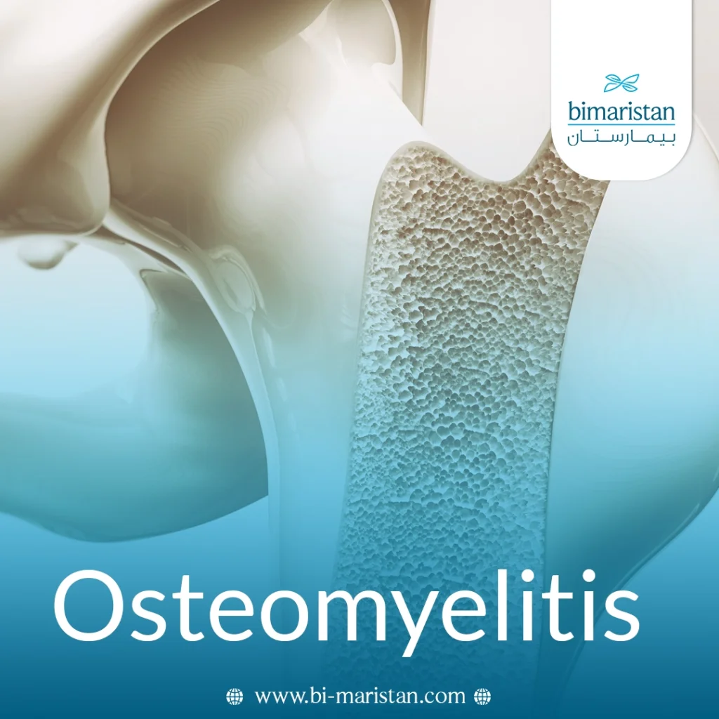 Osteomyelitis: Symptoms, Causes, And Comprehensive Treatment 8 Osteomyelitis