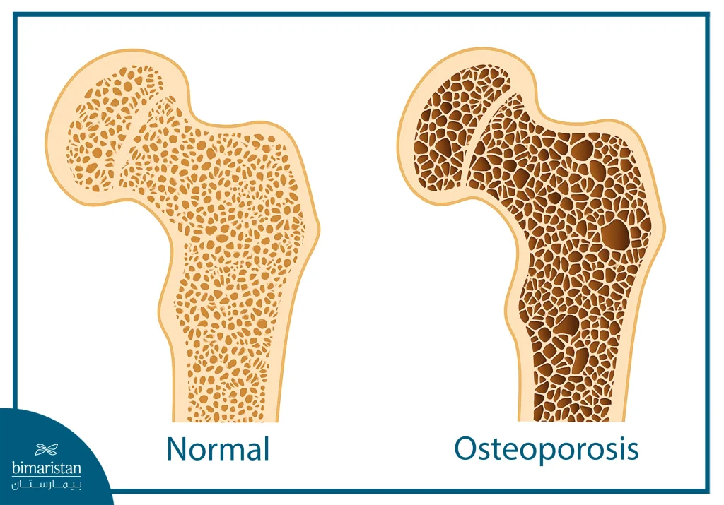 Osteoporosis One Of The Main Reasons For Undergoing The Ilizarov Surgery