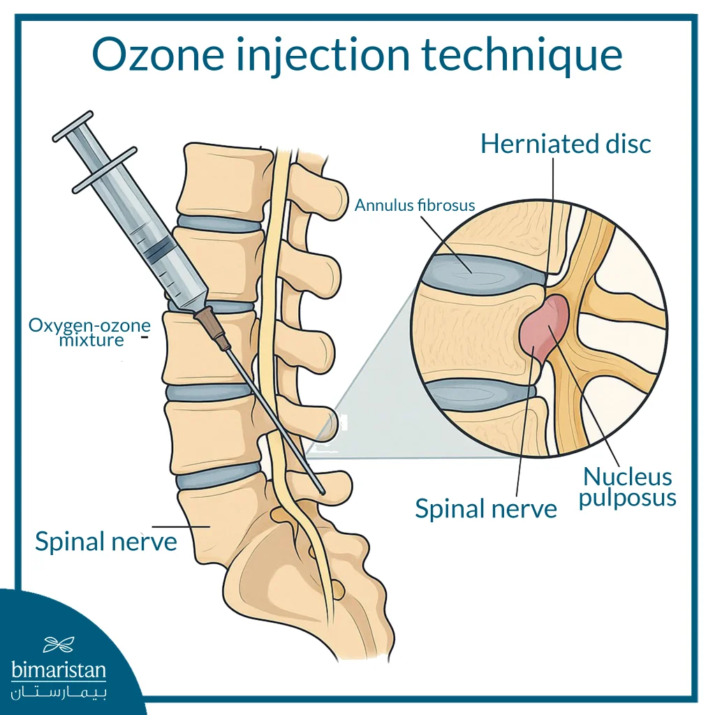 Ozone Therapy For Herniated Disc: A Modern Alternative To Surgery 4 Ozone Injection Technique