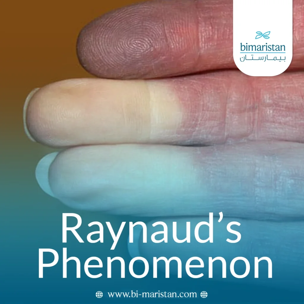 Raynaud’s Phenomenon