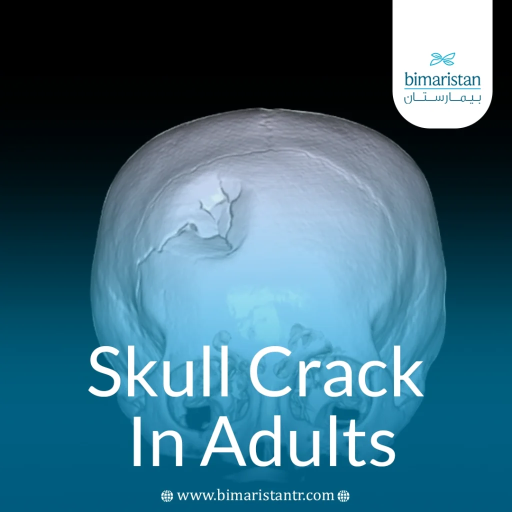 Treatment Of Skull Fracture In Adults