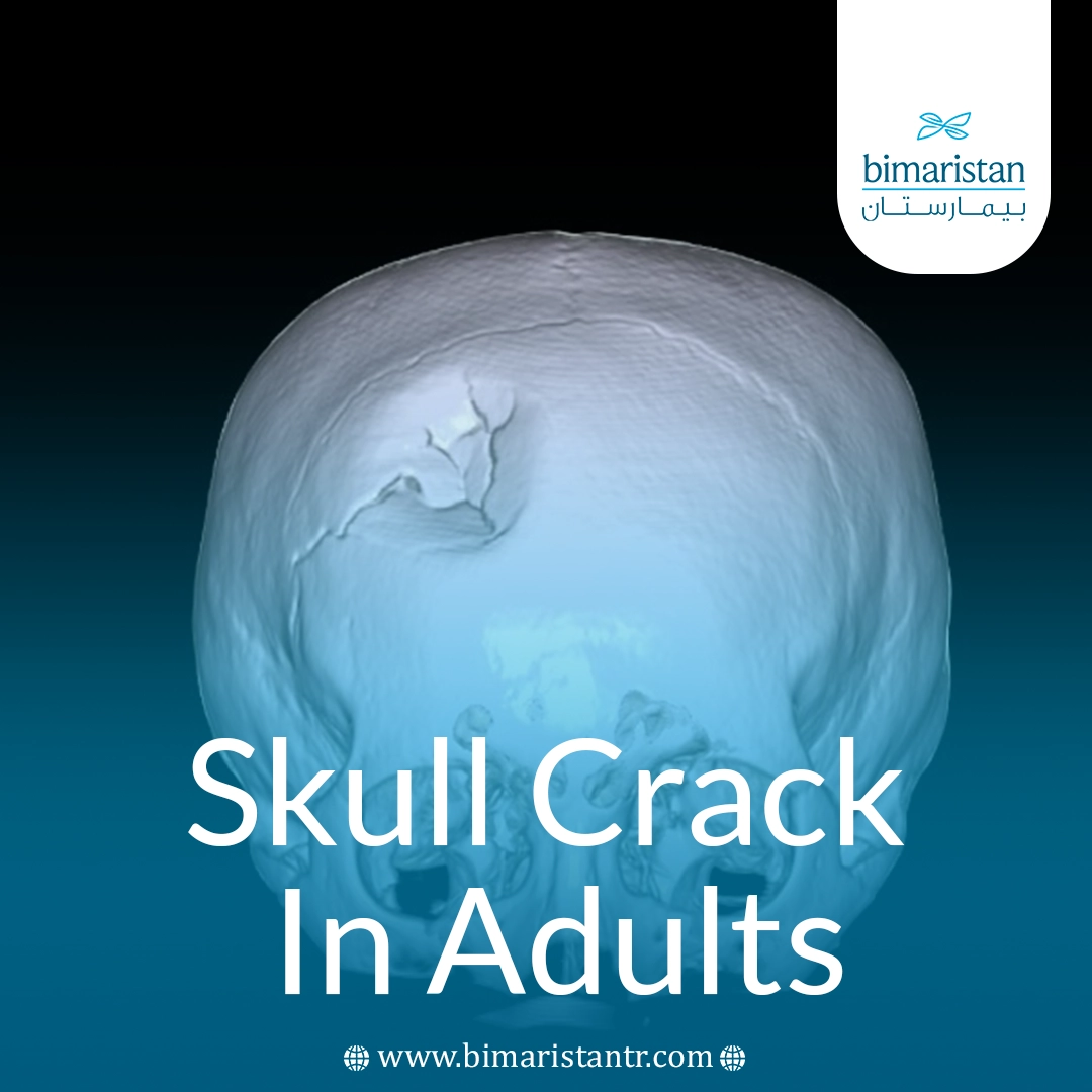 Treatment Of Skull Fracture In Adults