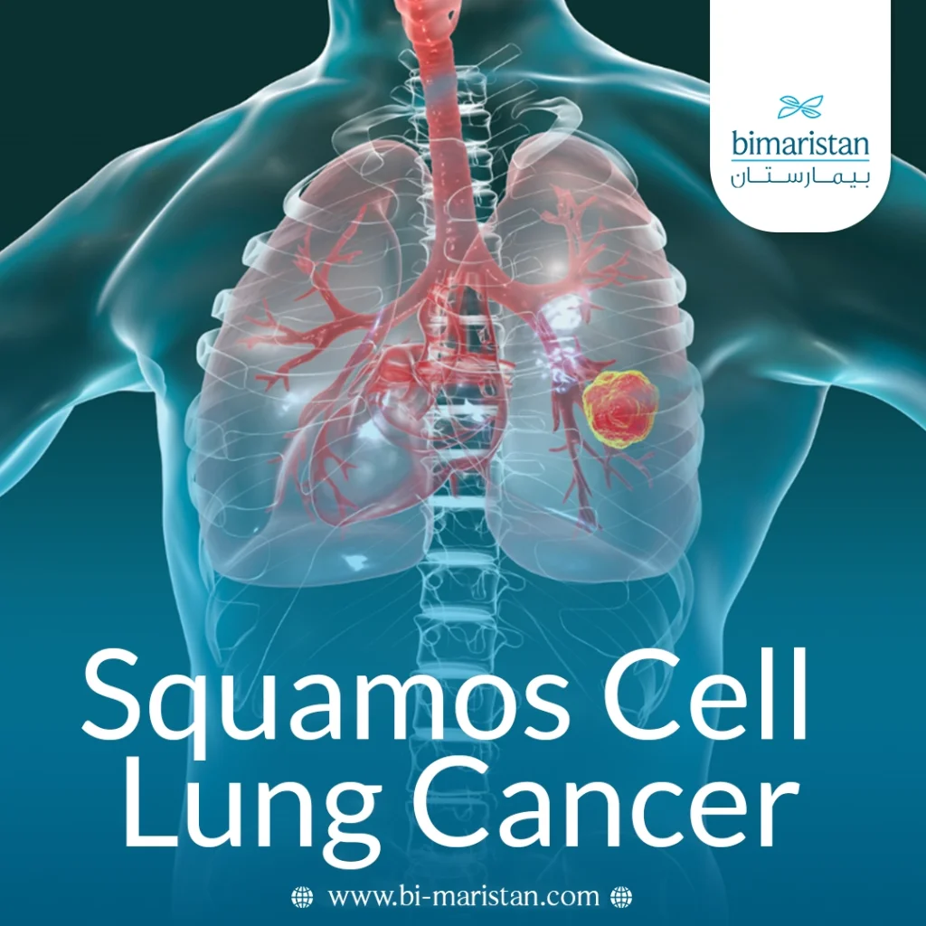 Squamos Cell Lung Cancer
