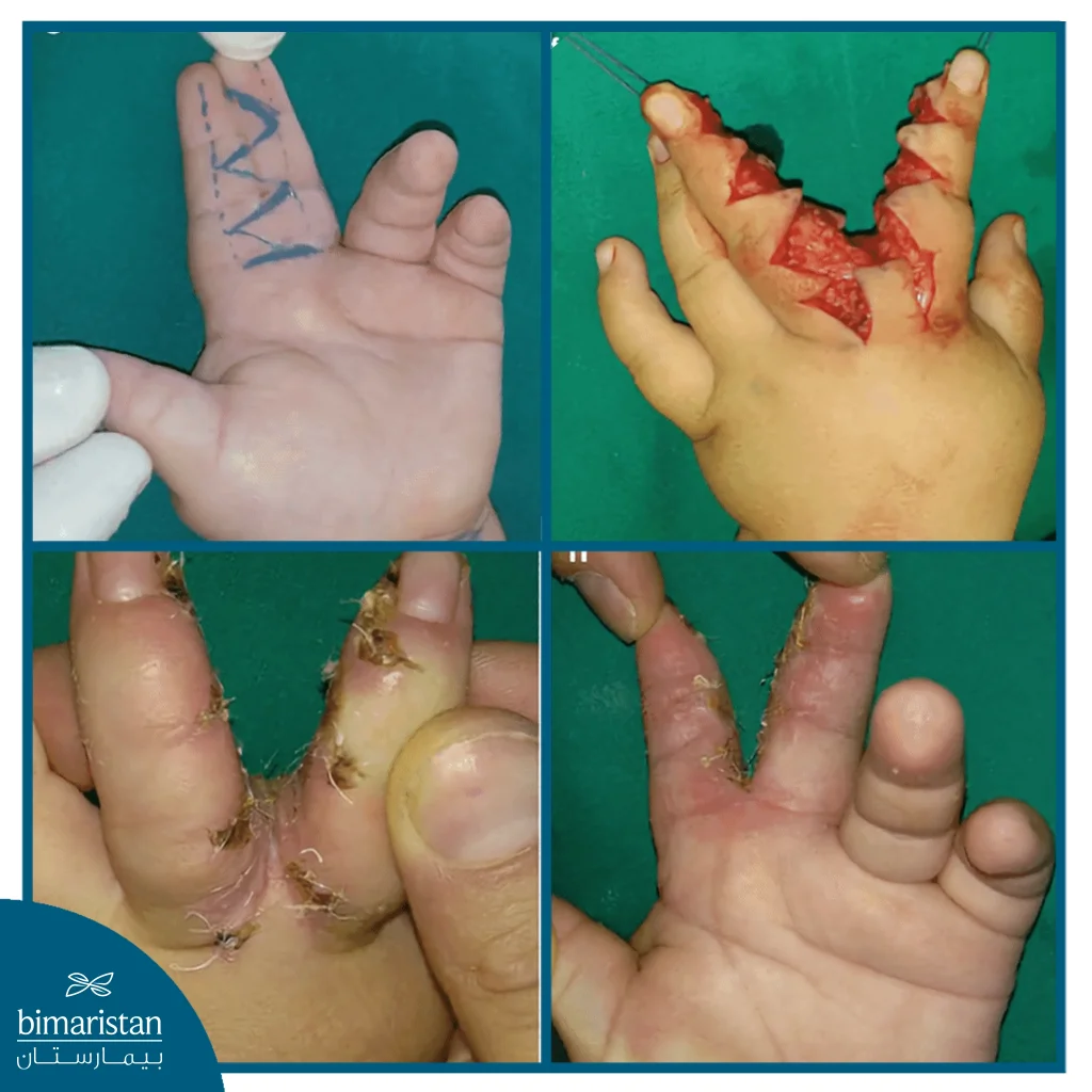Stages Of Syndactyly Release Surgery In Children