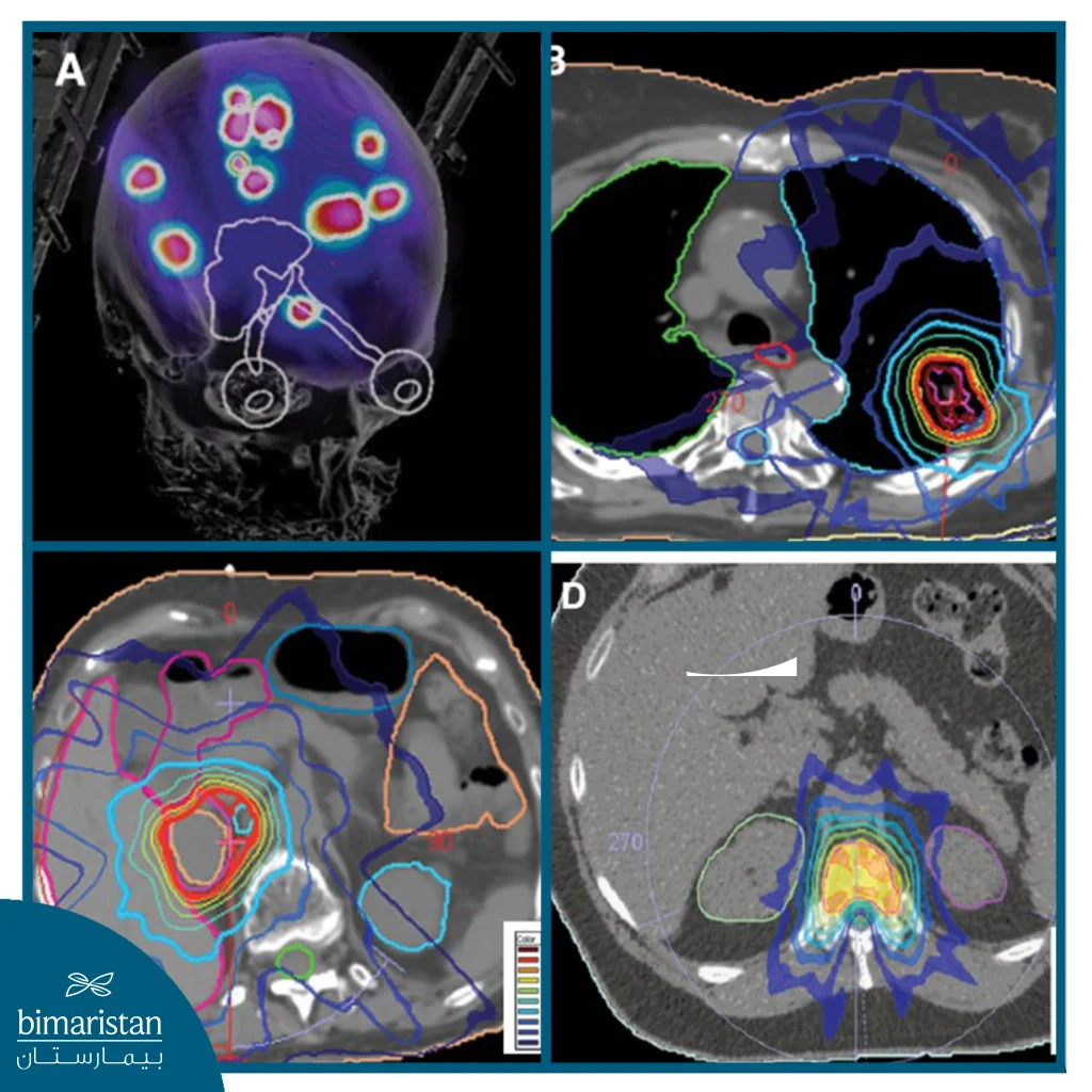 Stereotactic Radiotherapy Planning Images Showing Precise Radiation Dose Distribution Targeting Tumors In Different Body Regions