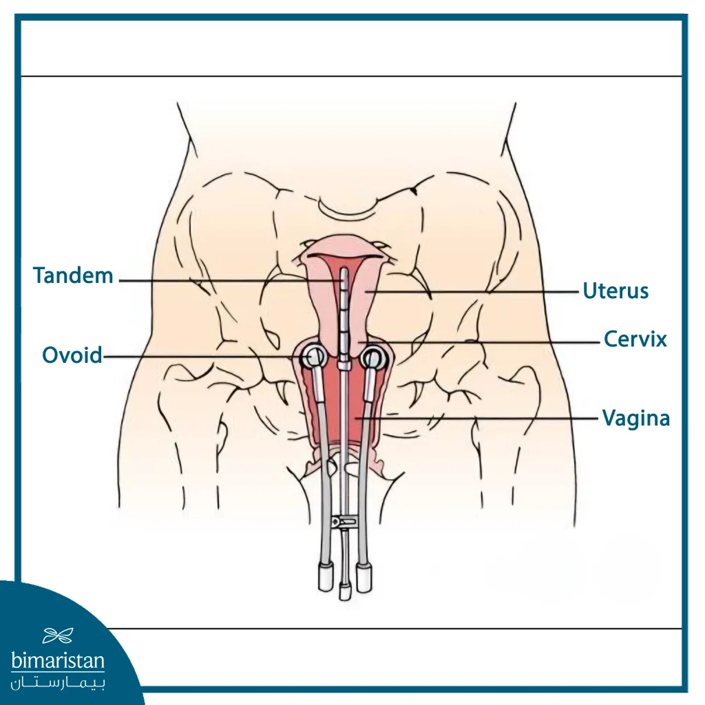 The Internal Radiation Therapy (Brachytherapy) Device Used In The Treatment Of Cervical Cancer Aims To Deliver A High Dose Of Radiation Directly To The Tumor While Minimizing The Impact On Surrounding Healthy Tissue