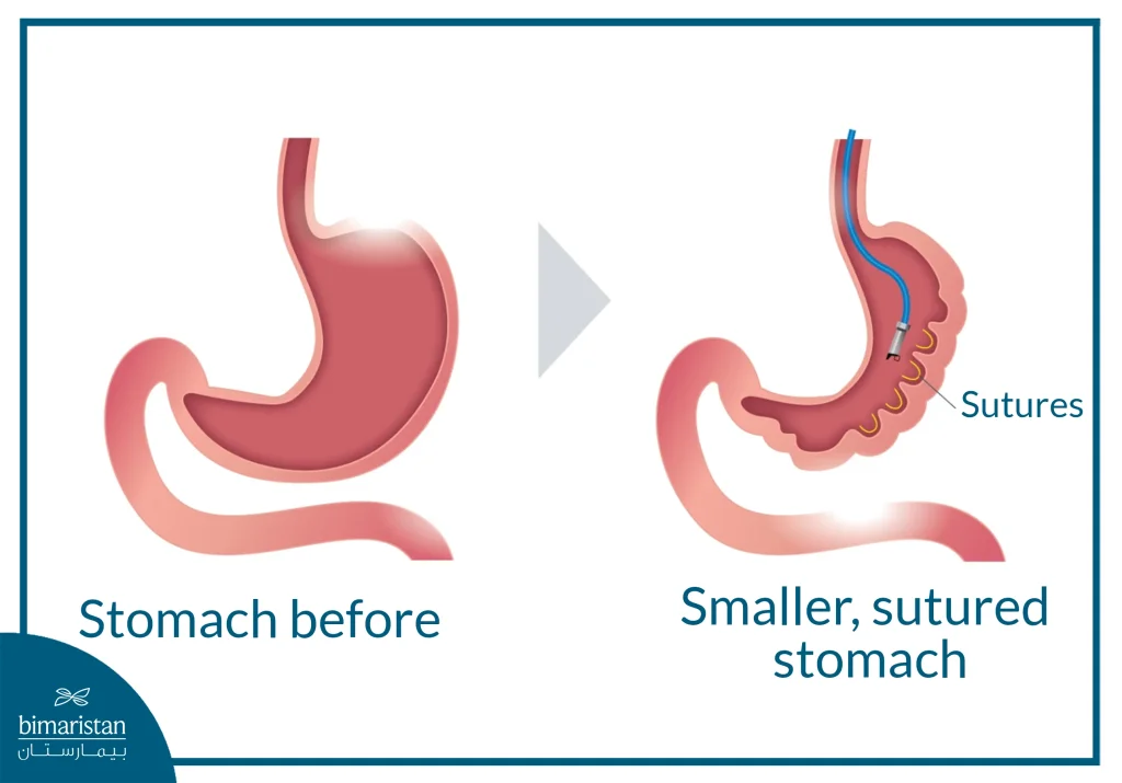 Endoscopic Sleeve Gastroplasty (Esg): The Modern Technique For Non-Surgical Weight Loss 3 The Difference Between The Stomach Before And After Esg.