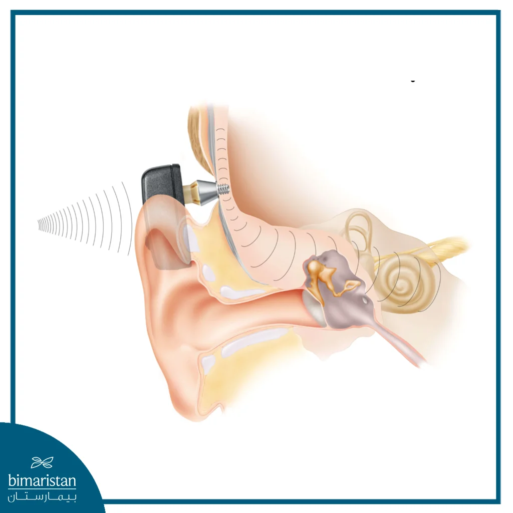 The Image Illustrates A Bone-Anchored Hearing Aid (Baha)