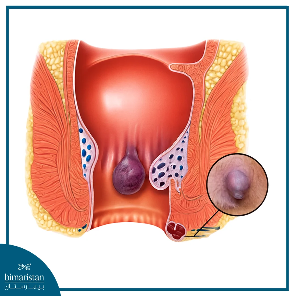 The Image Illustrates An Anal Hemorrhoid.
