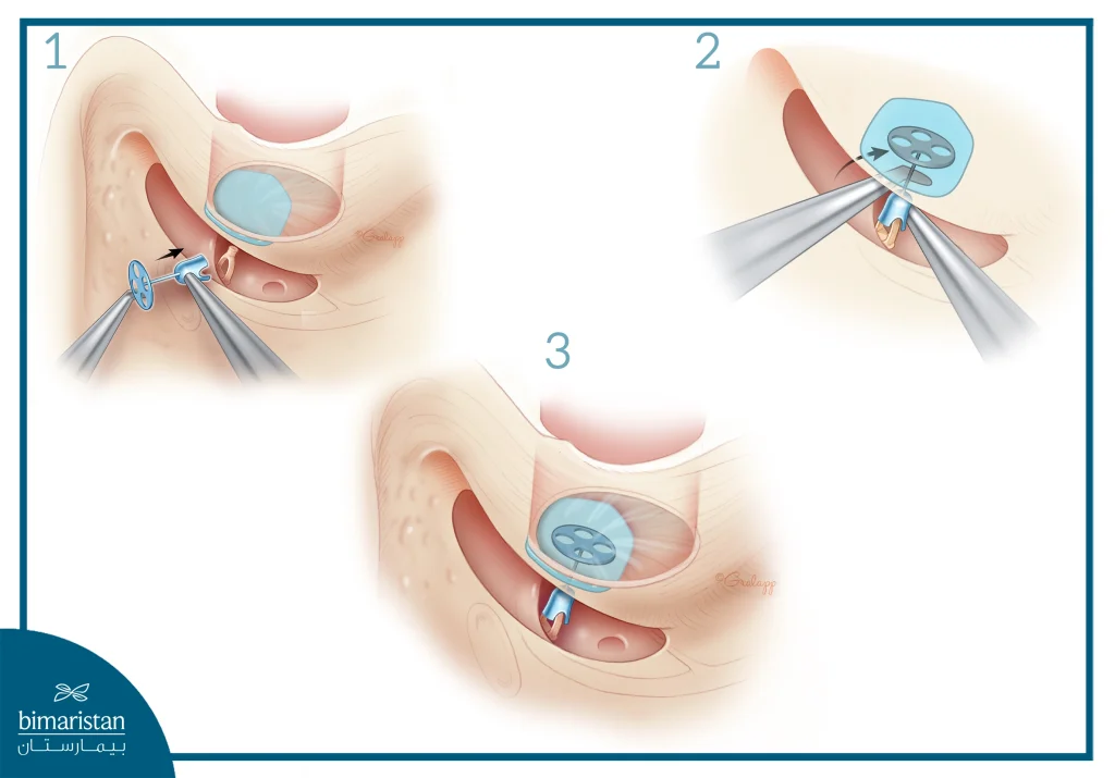 The Image Illustrates Ossiculoplasty.