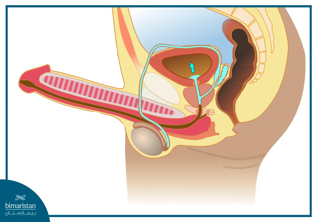The Image Illustrates Retrograde Ejaculation, One Of The Sexual And Fertility Problems After Spinal Cord Injury