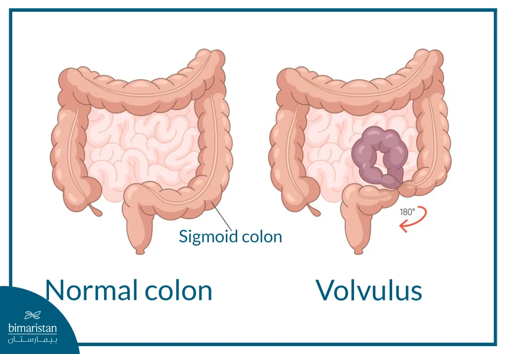 The Image Illustrates Sigmoid Colon Volvulus.