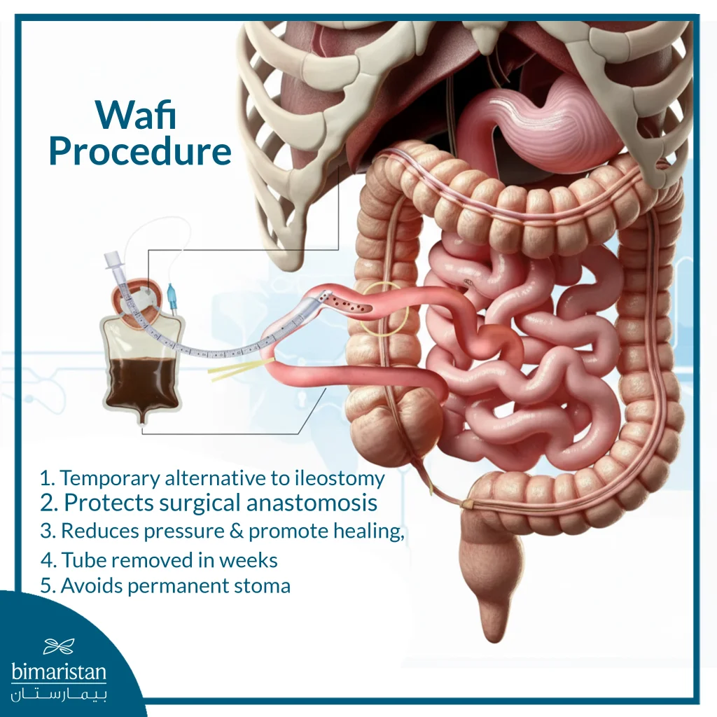 The Image Illustrates The Wafi Procedure, Which Is Considered An Alternative To Ileostomy.