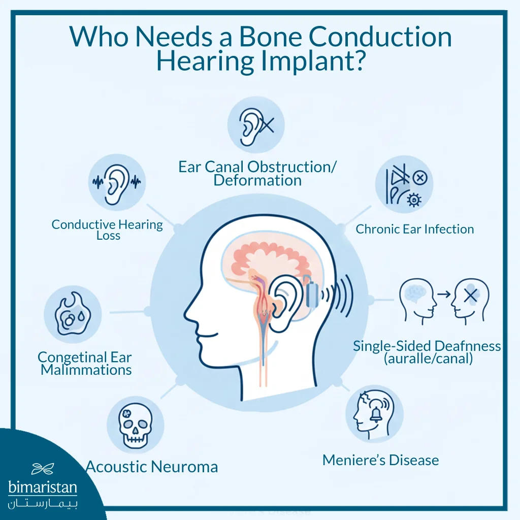 The Image Illustrates The Conditions That Require Bone Conduction Implants.