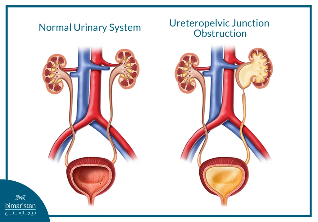 The Image Illustrates The Difference Between A Healthy Kidney And A Kidney Affected By Obstruction.