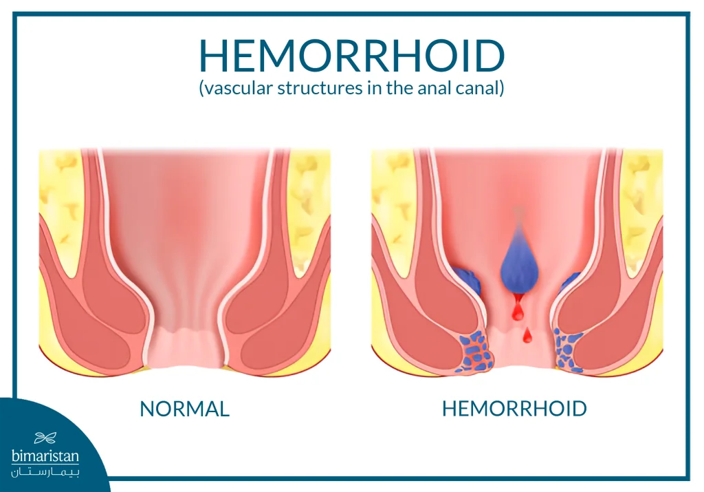 Hemorrhoid Banding: A Simple, Non‑Surgical Solution 2 The Image Illustrates The Difference Between A Normal Anal Canal And One Affected By Hemorrhoids.