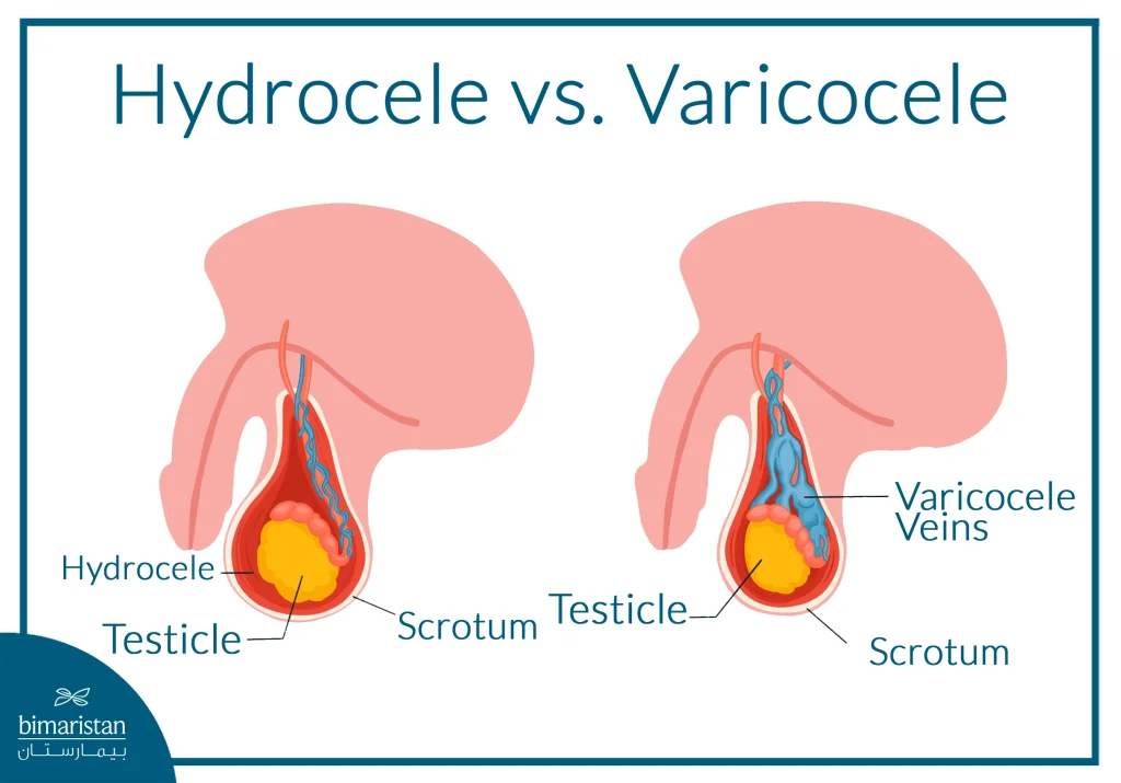 Laparoscopic Varicocele Surgery: To Treat Male Infertility 4 The Image Illustrates The Difference Between Varicocele And Hydrocele Around The Testicle.