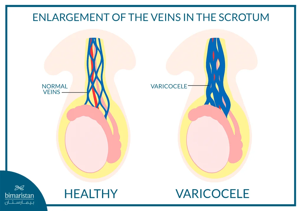 Laparoscopic Varicocele Surgery: To Treat Male Infertility 2 The Image Illustrates The Dilation Of Veins Within The Scrotal Sac.