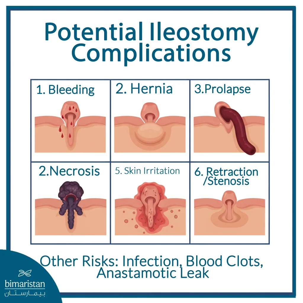 The Image Illustrates The Possible Complications Of An Ileostomy.