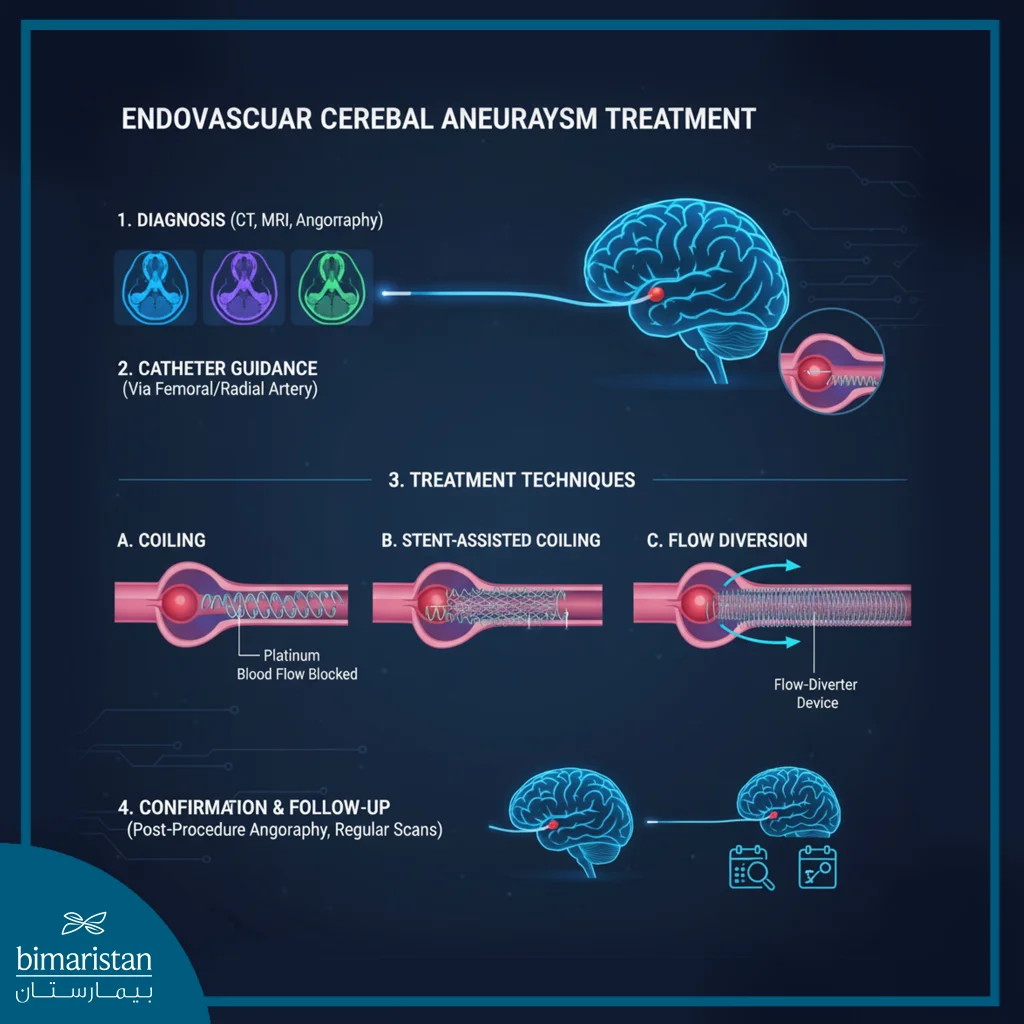 The Image Illustrates The Steps Of Cerebral Aneurysm Treatment Using The Interventional Technique.