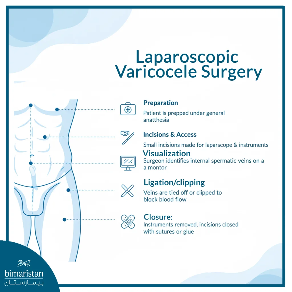 Laparoscopic Varicocele Surgery: To Treat Male Infertility 3 The Image Illustrates The Steps Of Laparoscopic Varicocele Surgery.