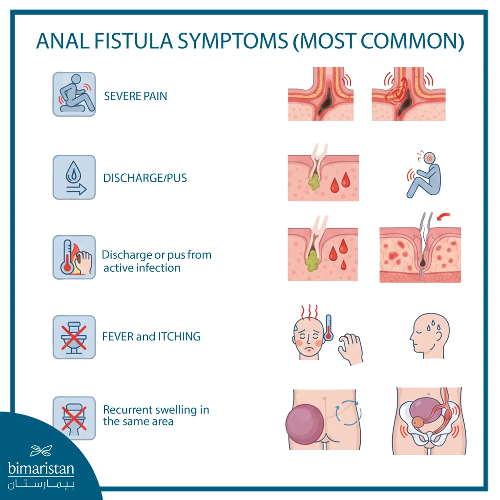 The Image Illustrates The Symptoms Of An Anal Fistula.