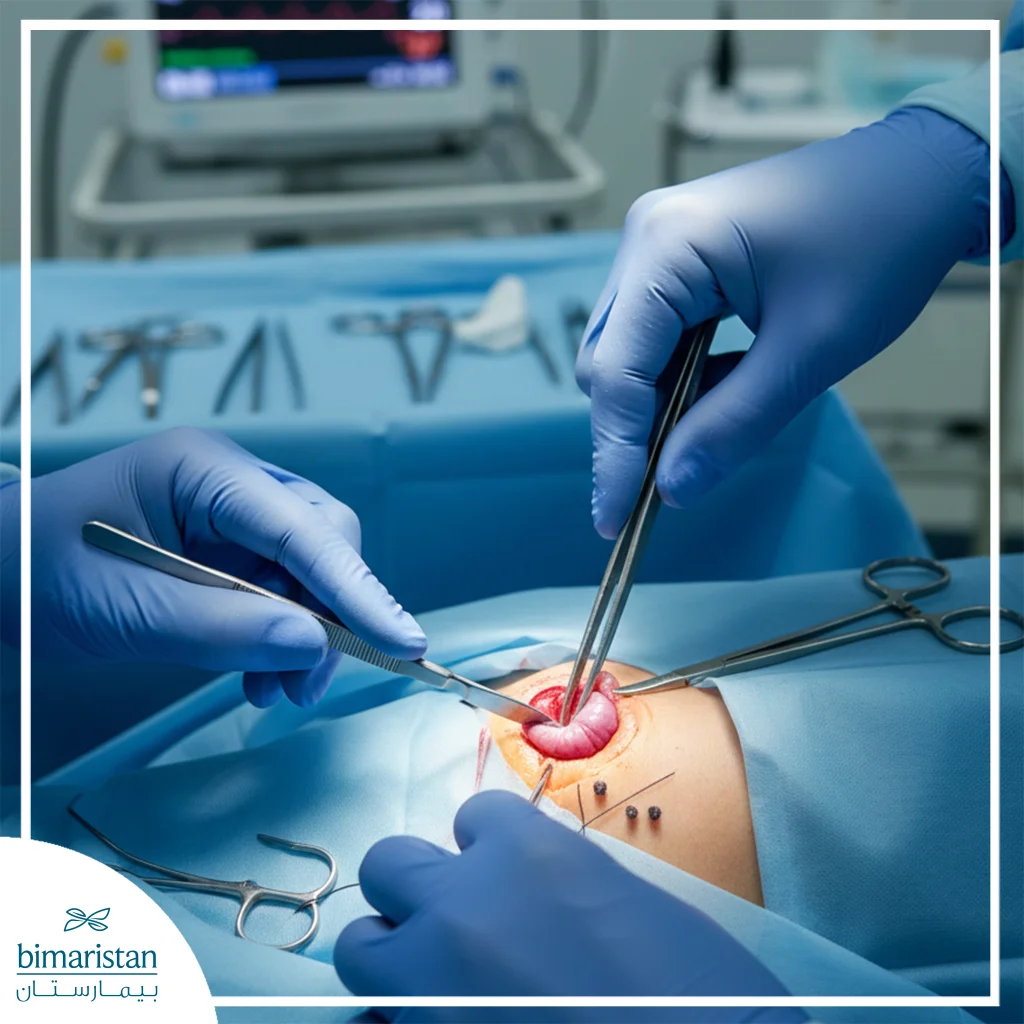 The Image Illustrates Traditional Surgical Hemorrhoidectomy.